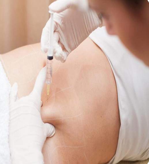 Tratamento para Estrias