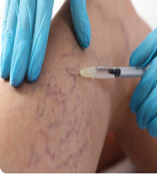 Escleroterapia (PEIM)